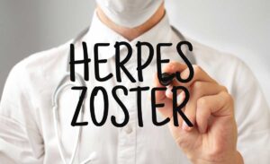 Herpes-Zoster-Complications-and-Prevention-Strategies