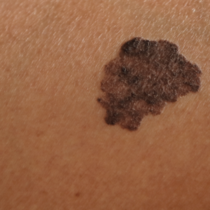 close up shot of potentially cancerous mole