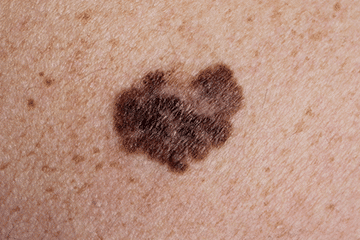 Melanoma