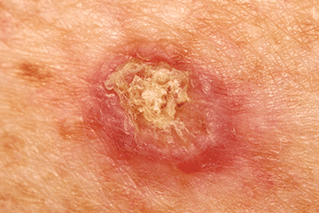 Squamous Cell Carcinoma