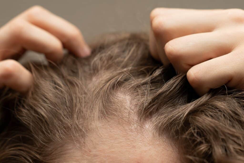 Close-up,Of,A,Person,Scratching,Their,Scalp,,Highlighting,Hairline,And